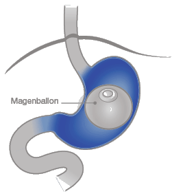 Magenballon